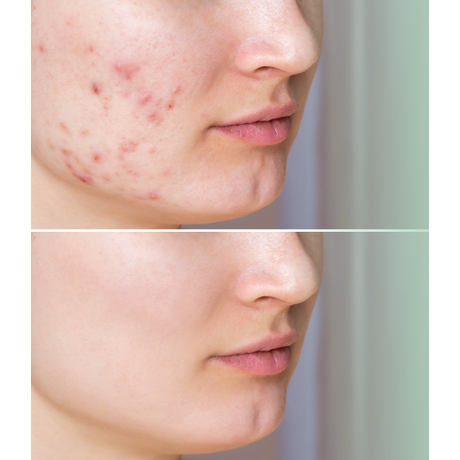 Afrodita BEAUTY FILLER SHOTS MULTIACTIVE Szalicilsavas BHA SHOT